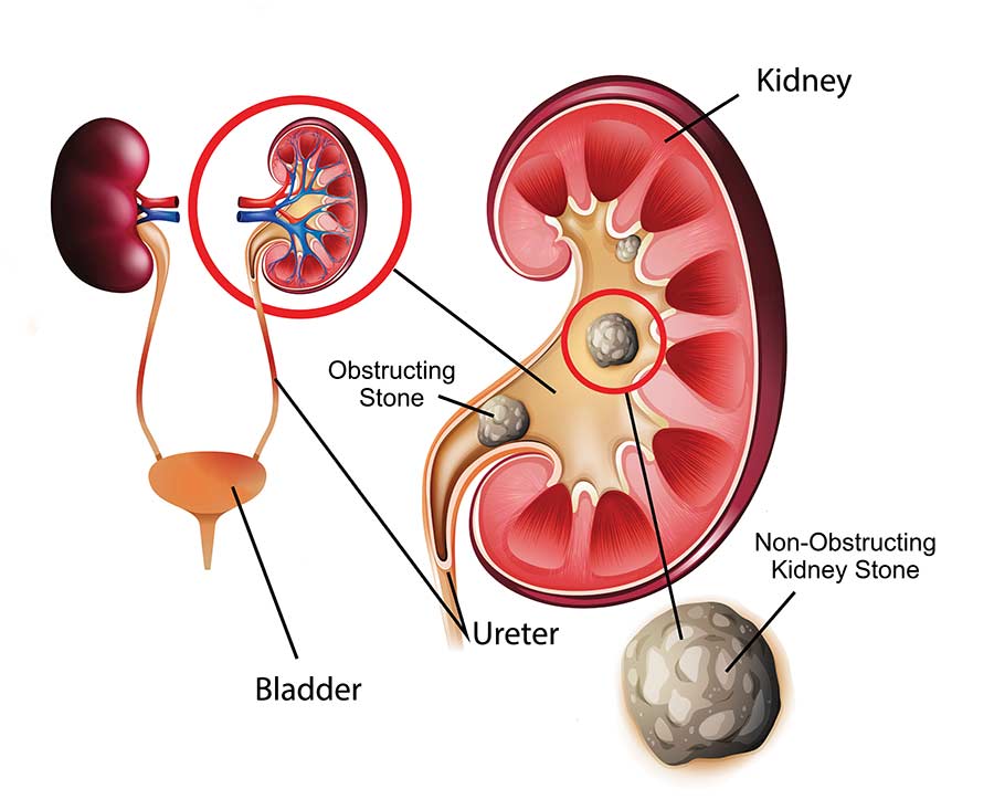 Debunking Common Myths About Kidney Stones: Clarifying Facts and Misconceptions